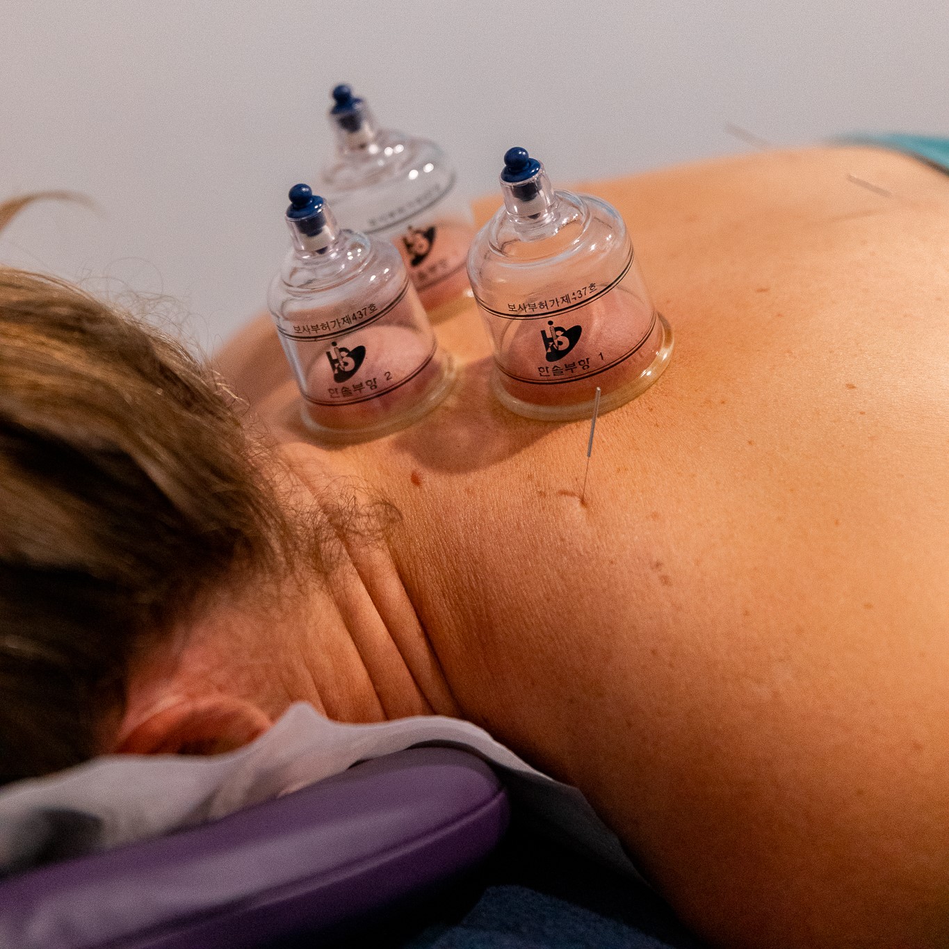 cupping